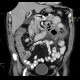 Jejunal diverticulitis, diverticulosis: CT - Computed tomography